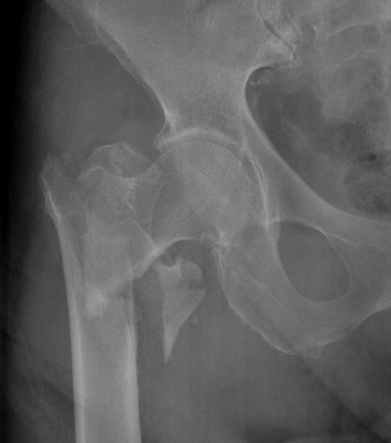 Four Part Inter trochanteric fracture